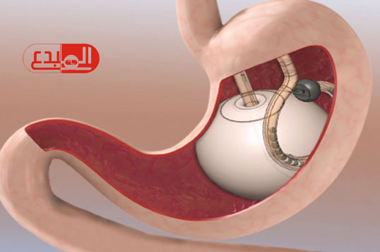 “FDA” تكشف عن 5 حالات توفيت بسبب بالون المعدة فى أمريكا