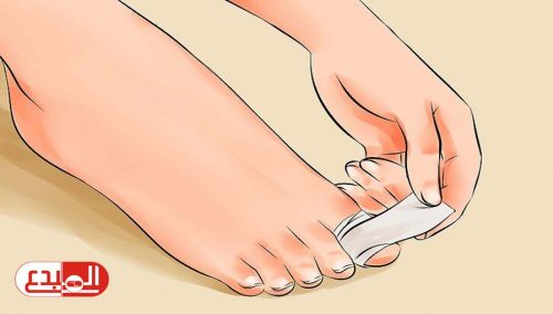 اكتشاف دواء لفطريات القدم يساعد في علاج سرطان الأمعاء