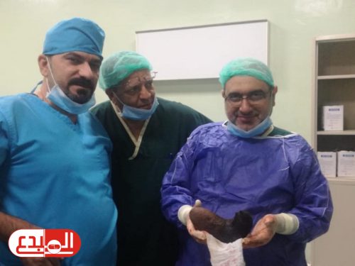 فريق طبي ينجح بإجراء عملية لإخراج كتلة من الشعر داخل معدة مريضة
