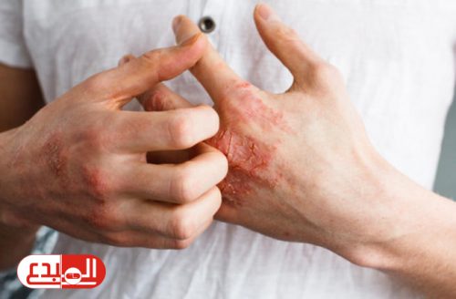 علاج جديد لحساسية الجلد باستخدام الضوء