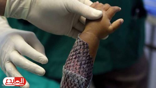 استخدام جلد الاسماك لعلاج الحروق