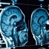 تقنية جديدة قد تساعد في استئصال أورام الدماغ بدقة