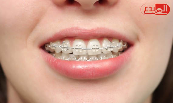 بروفيسور بريطاني : التقويم يسبب أضرارا باللثة وتراكم البلاك على الأسنان