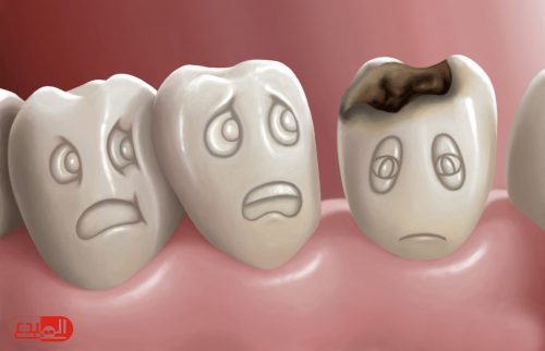 دراسة: الأسبرين علاج لتسوس الأسنان !
