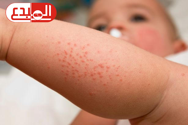 الأطفال المصابين بفيروس كورونا المستجد قد يعانون من مرض كاواساكي